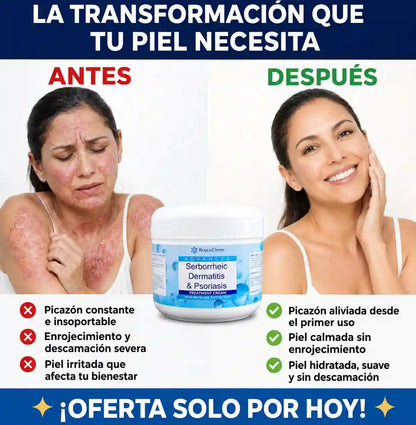 RoyceDerm™ | Alivia la picazón, controla la descamación e hidrata tu piel